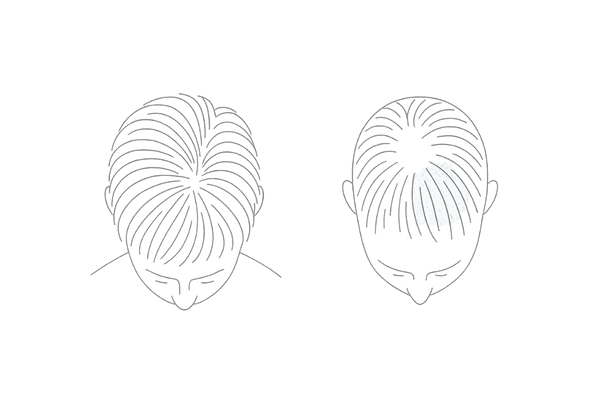 正常なつむじと薄毛が進行したつむじの比較イラスト｜頭頂部（つむじ）の見え方の違い
