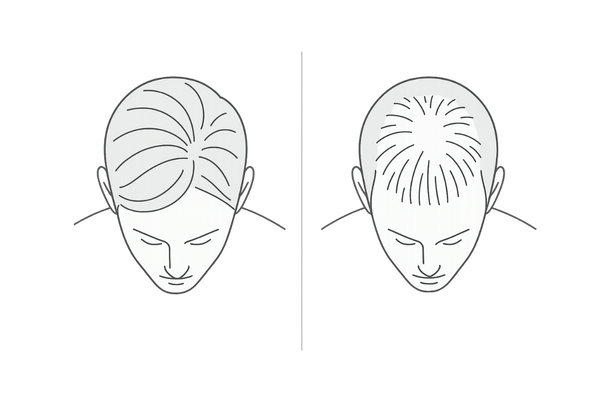 正常なつむじとAGAつむじ（頭頂部薄毛）の視覚比較イラスト