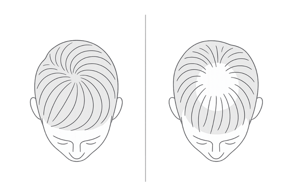 つむじの構造とAGA進行の比較図(健常と薄毛の見え方)