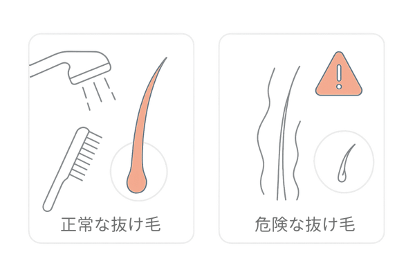 20代の正常な抜け毛と危険な抜け毛の見分け方（イラスト解説）
