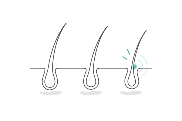アンドロゲン受容体の感受性が高い毛根の抽象図（反応の強さ）