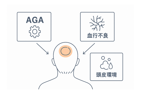 つむじ薄毛の全体像：AGA・血行・頭皮環境の三要因