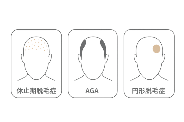 休止期脱毛症・AGA・円形脱毛症の見た目パターン比較(うつ病関連のびまん性脱毛)