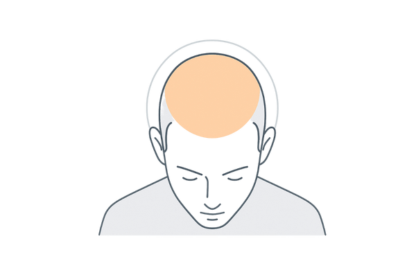 生え際と頭頂部に集中する感受性：5αリダクターゼ・受容体分布の抽象図