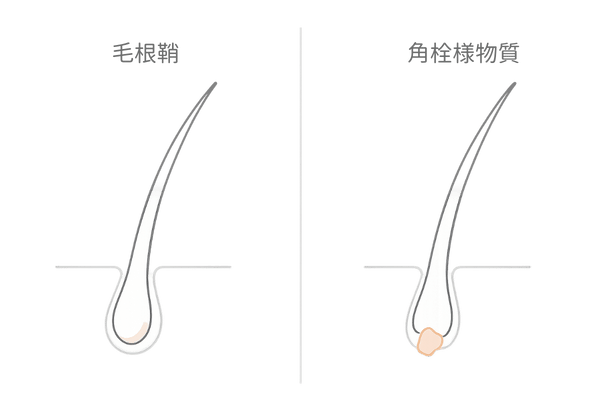 毛根鞘と角栓様物質の見分け方｜左右比較イラスト（抜け毛の白い塊）