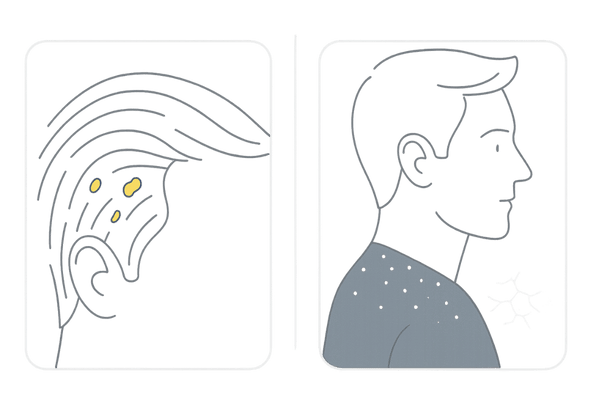 脂性フケと乾性フケの違い|男性の頭皮トラブルの見分け方イラスト