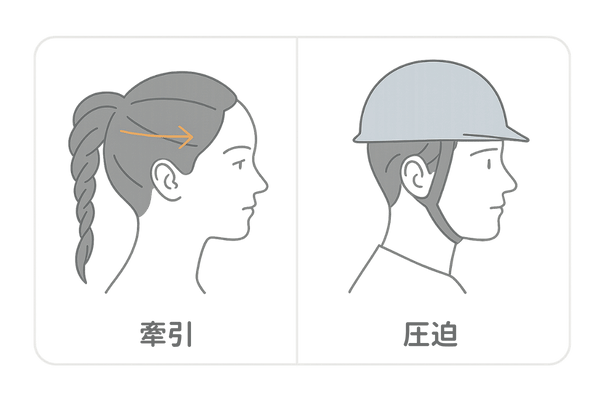 牽引性脱毛症と圧迫性脱毛症の違い（髪型の張力／帽子・分け目による圧迫の比較）