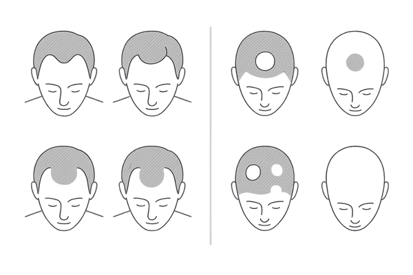 AGAと円形脱毛症の進行パターン比較(M字・O字と単発・多発・全頭)