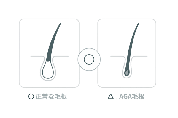 正常な毛根とAGA毛根の見分け方｜丸みのある棍棒状と細く尖る萎縮毛根の比較イラスト