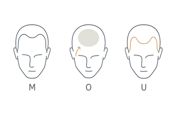 AGAの3タイプ（M字・O字・U字）の違いがひと目でわかる図解｜M/O/Uの進行部位比較