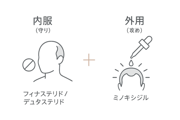 M字型AGAの治療アプローチ図解｜内服（守り）＋外用（攻め）の併用