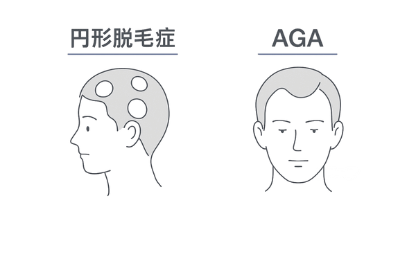 円形脱毛症とAGAの違い｜原因・症状・対処を一目で比較（円形脱毛症は自己免疫、AGAはDHT）