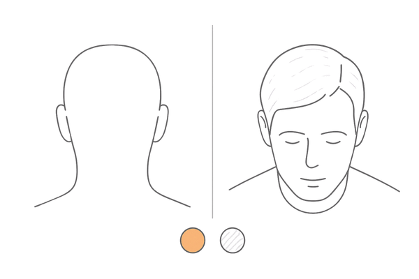 円形脱毛症とAGAの違い比較図（境界明瞭 vs びまん性）