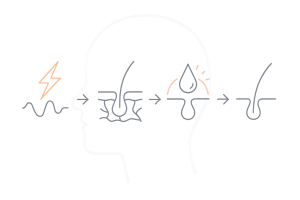 自律神経の乱れが抜け毛を招くメカニズム｜血行不良・皮脂過多・睡眠低下のフロー