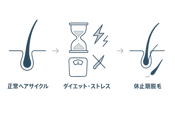 ダイエットによる休止期脱毛の流れ（ヘアサイクル短縮と抜け毛増加の図解）