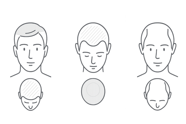 AGA初期の進行パターン比較（M字・O字・U字）｜男性型脱毛症 パターン 視覚化