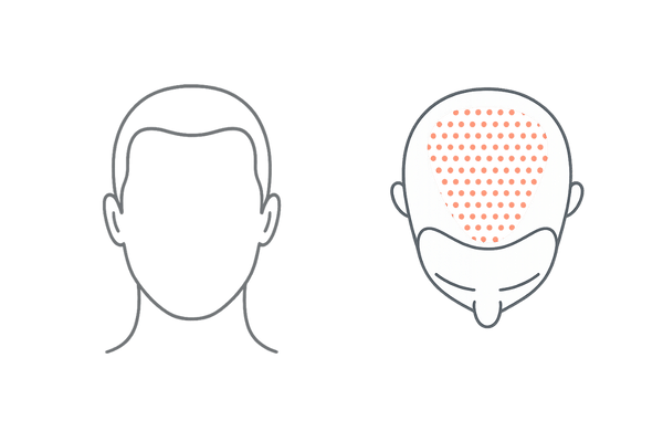 おでこから薄毛が目立つ理由（5αリダクターゼ分布とヘアラインの解剖イメージ）