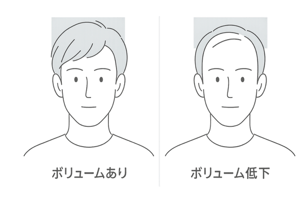 前髪ボリューム低下が顔の印象に与える影響|額縁効果の比較図(前髪の抜け毛・分け目の薄毛)