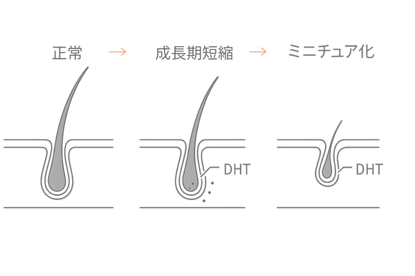 AGAの仕組み図：DHTによる前頭部の成長期短縮とミニチュア化（前頭部薄毛・生え際後退の原因）