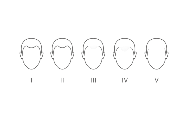 前頭部薄毛の進行度（ハミルトン・ノーウッド分類 簡易イラスト：I～V段階の視覚化）