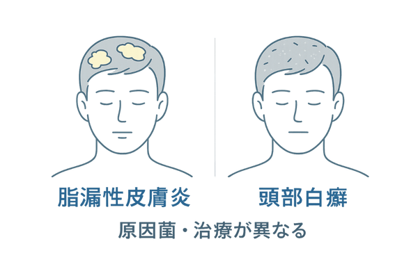 脂漏性皮膚炎との見分け方（黄ばみフケ vs 乾燥フケ＋断毛）