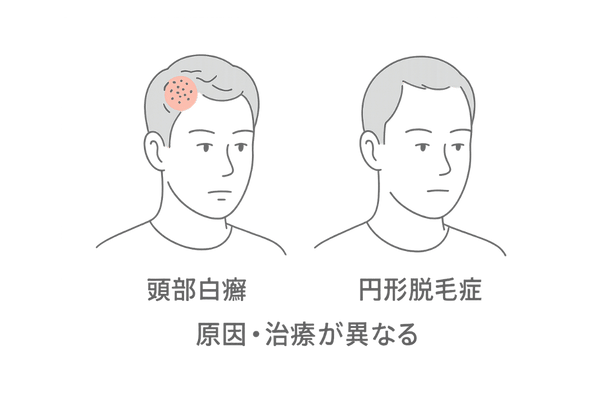 円形脱毛と頭部白癬の見分け（黒点毛・鱗屑・境界）