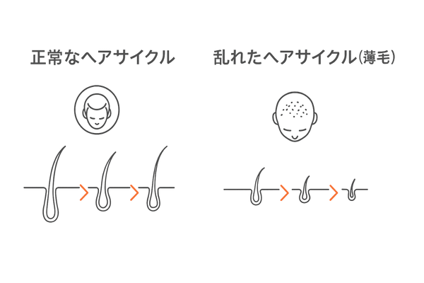 正常なヘアサイクルと乱れの違い（薄毛の医学的判定イメージ図）