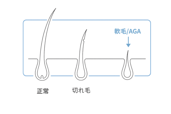 正常な抜け毛と切れ毛・AGA軟毛の毛根比較図
