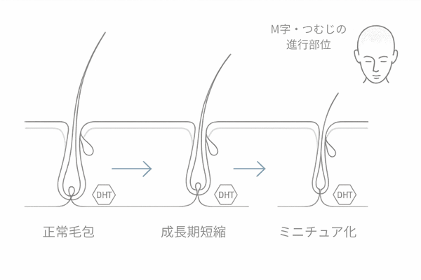 AGAメカニズム図：DHTによる毛包ミニチュア化とM字・つむじの進行イメージ