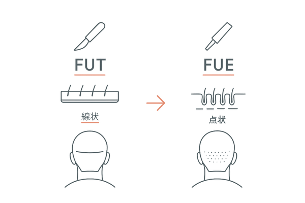 FUT法とFUE法の違い：採取方法と傷跡の見え方を比較する左右2カラム図