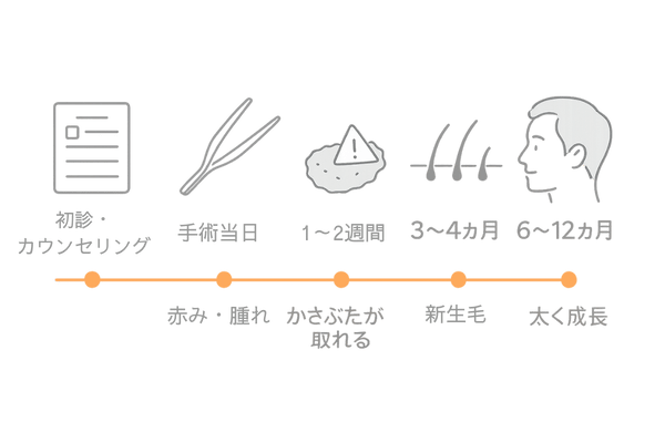 毛髪移植の時系列：初診から術後6〜12か月の変化を示す横長タイムライン