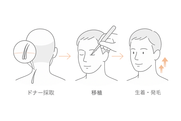 毛髪移植の仕組み：ドナー採取から生着・発毛までの3ステップ図（FUT/FUE共通）