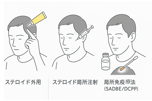 生え際の円形脱毛症に対する主な治療法の比較（外用・局所注射・局所免疫療法）