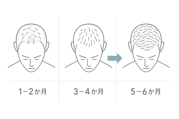 ハーグ(HARG)療法の効果推移|6か月スケジュールと実感のタイムライン(抜け毛減少→産毛→密度増加)