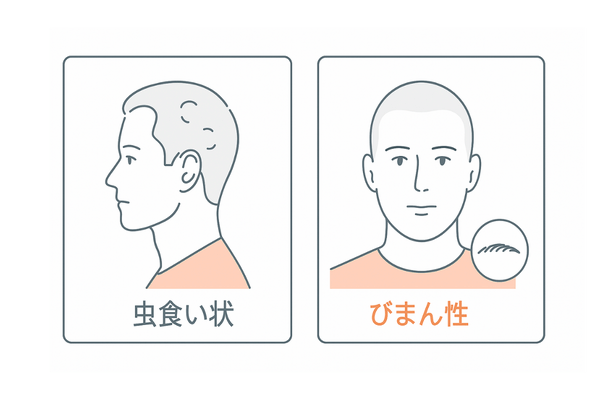 梅毒性脱毛のパターン｜虫食い状とびまん性の2タイプ