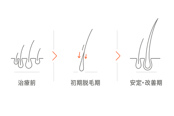 初期脱毛の流れとヘアサイクル正常化の図（AGA治療の基礎）