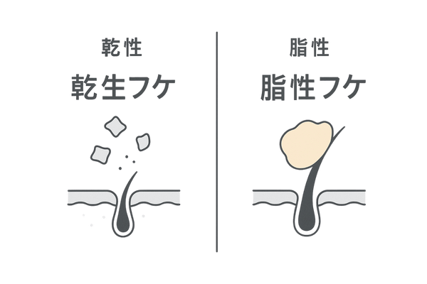 乾性フケと脂性フケの違い（見分け方の2カラム比較イラスト）