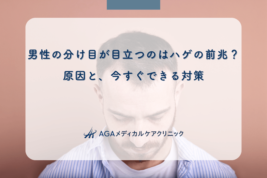 男性の分け目が目立つのはハゲの前兆？原因と、今すぐできる対策