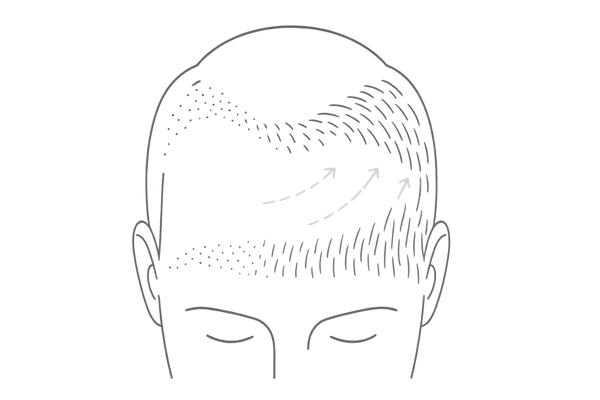 植毛がバレない生え際デザイン｜産毛グラデーションと微細な不規則性