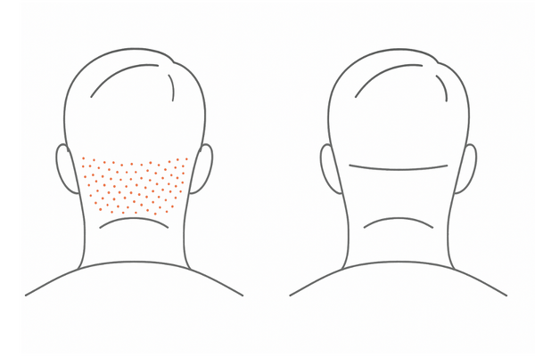 FUEとFUTの術跡の違い｜点状瘢痕と線状瘢痕の比較