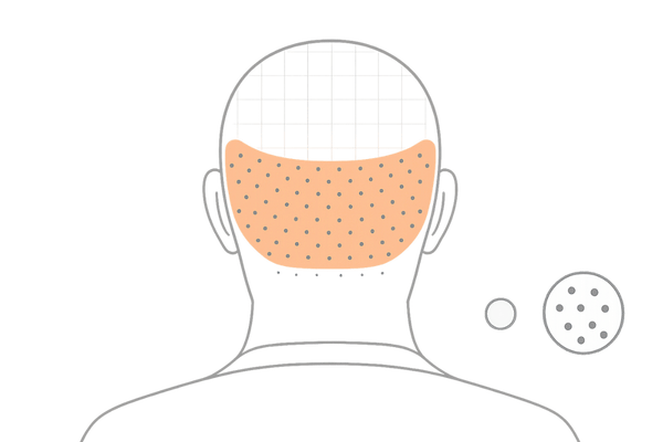 ドナー採取の分散計画とパンチ径の考え方｜傷跡を目立たせない工夫