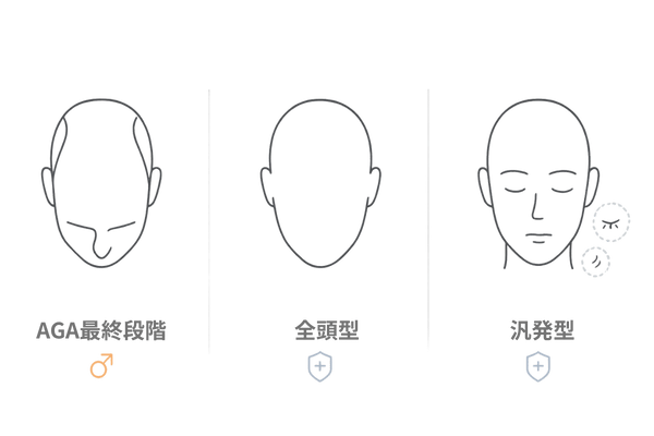 脱毛症タイプの比較図：AGA最終段階と全頭型・汎発型の違い（横長インフォグラフィック）