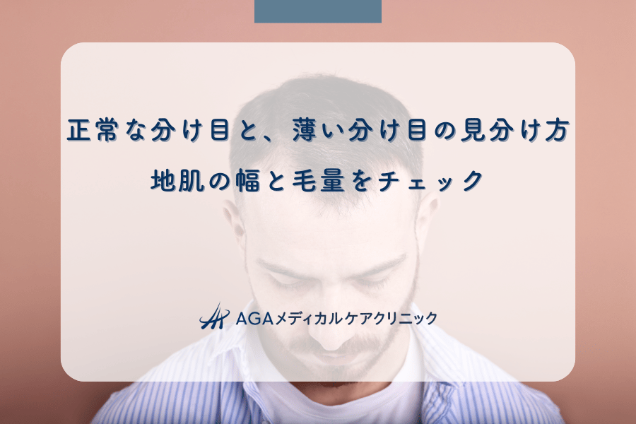 正常な分け目と、薄い分け目の見分け方｜地肌の幅と毛量をチェック