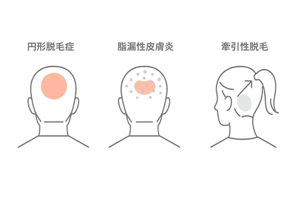 円形脱毛症・脂漏性皮膚炎・牽引性脱毛