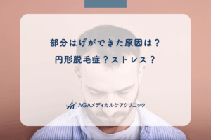 部分はげができた原因は？円形脱毛症？ストレス？