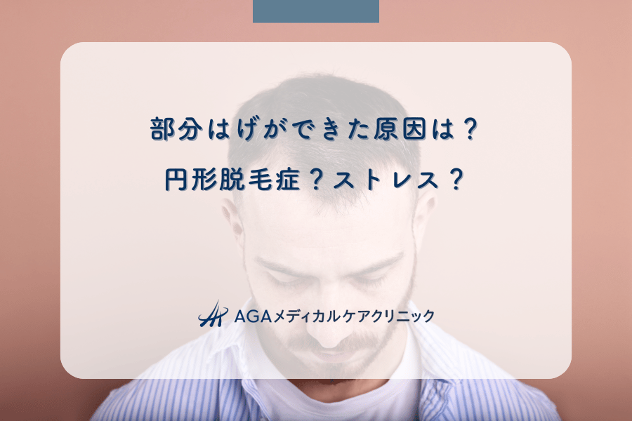 部分はげができた原因は？円形脱毛症？ストレス？