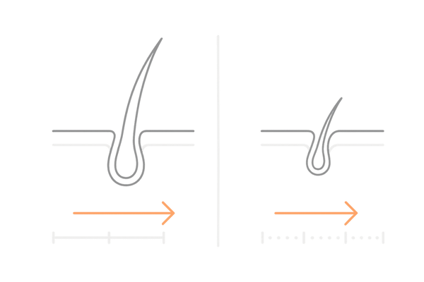 AGAの急激な進行｜ヘアサイクル正常と乱れの比較図