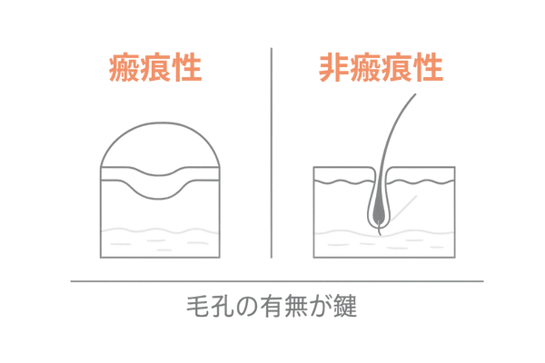 瘢痕性と非瘢痕性の違い：毛孔の有無と皮膚所見の比較