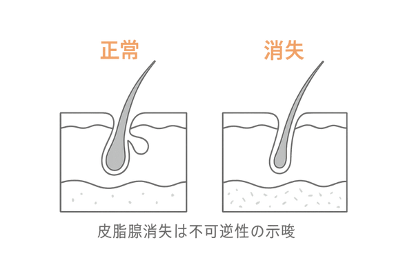皮脂腺の消失所見：正常と障害の断面比較