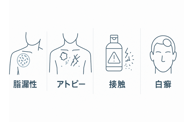 かゆみを伴う頭皮疾患の見分け方：脂漏性・アトピー性・接触性・頭部白癬の4カラム比較
